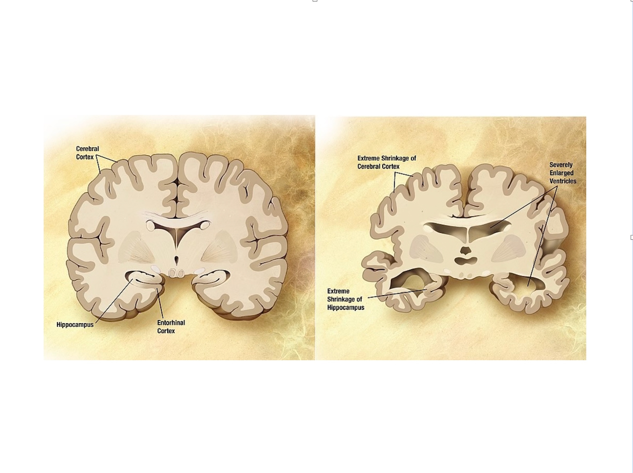 Alzheimers disease brain comparison